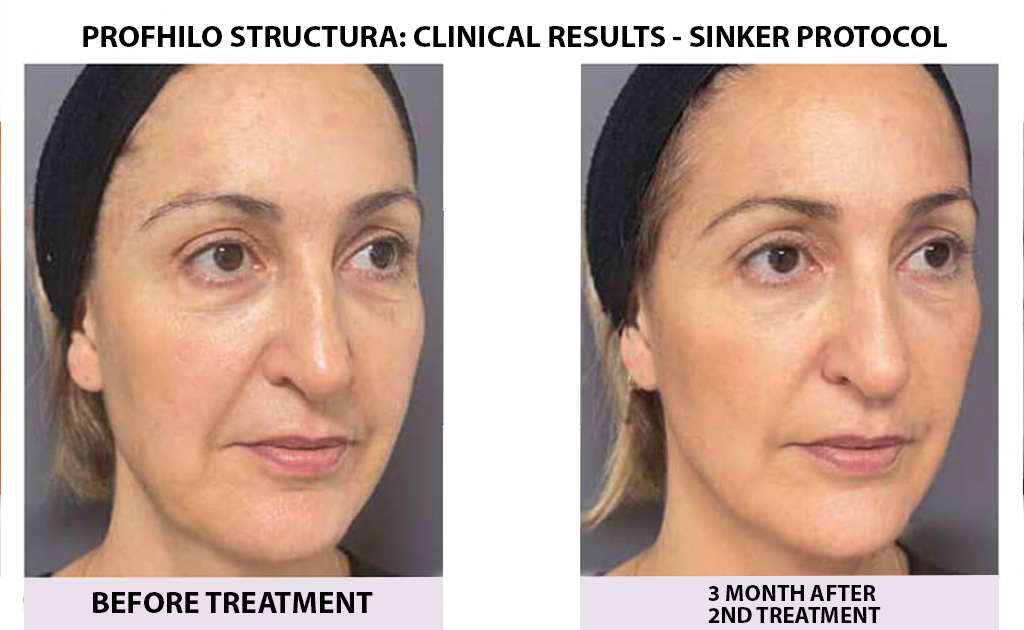 bEFORE-AND-AFTER-PROFHILO-03