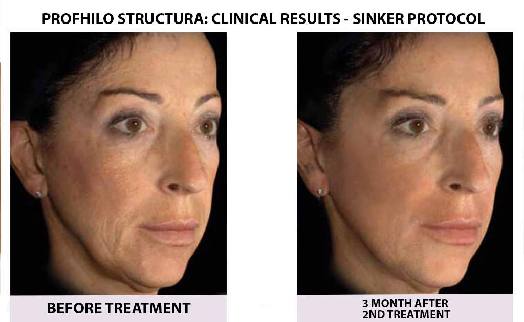 bEFORE-AND-AFTER-PROFHILO-04