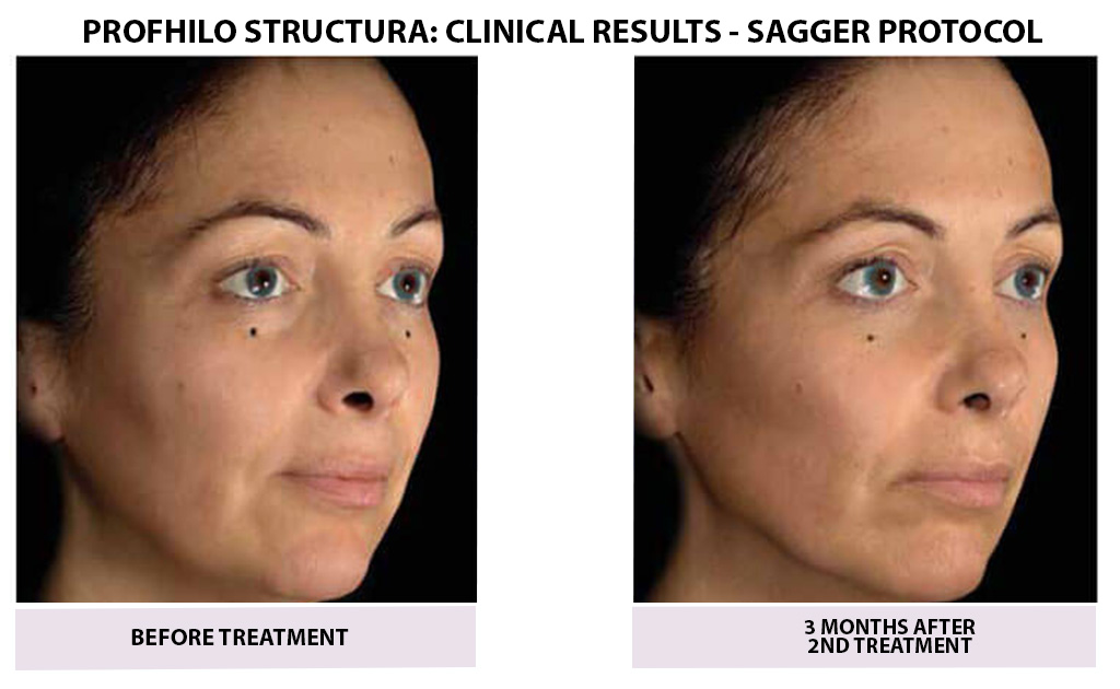 bEFORE-AND-AFTER-PROFHILO-06