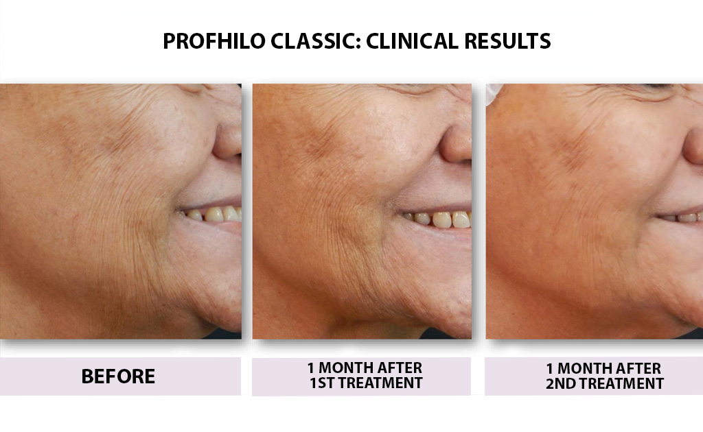 bEFORE-AND-AFTER-PROFHILO-classic-01