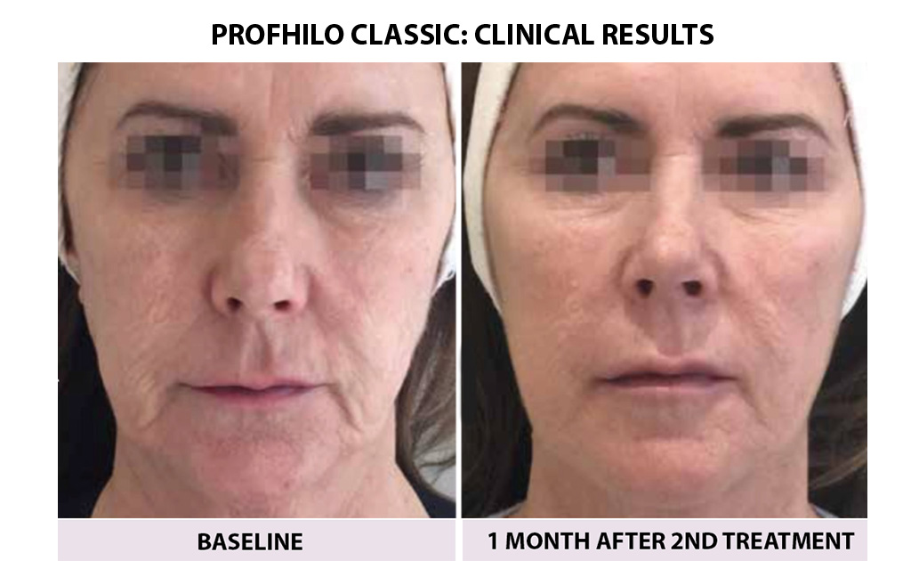 bEFORE-AND-AFTER-PROFHILO-classic