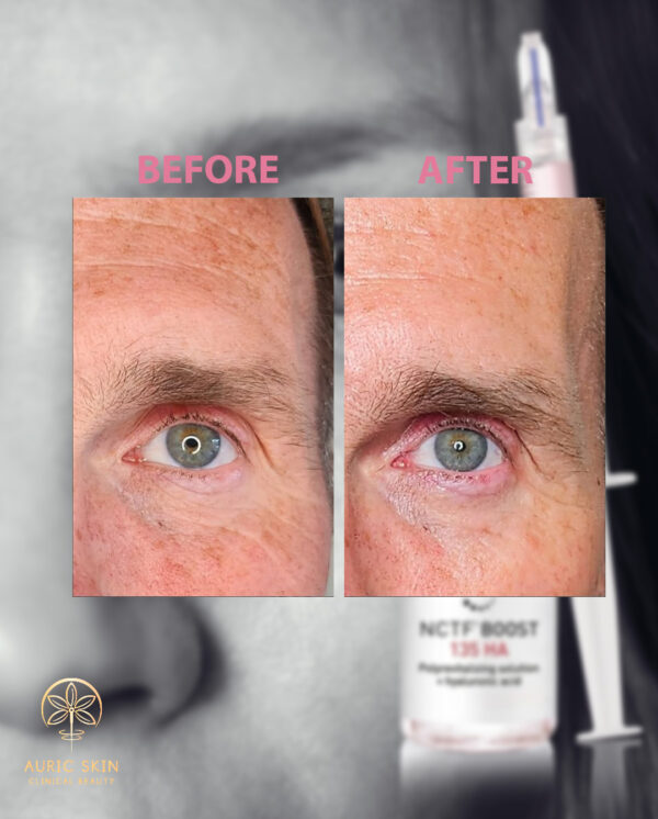NCTF-Before-and-after-image-02