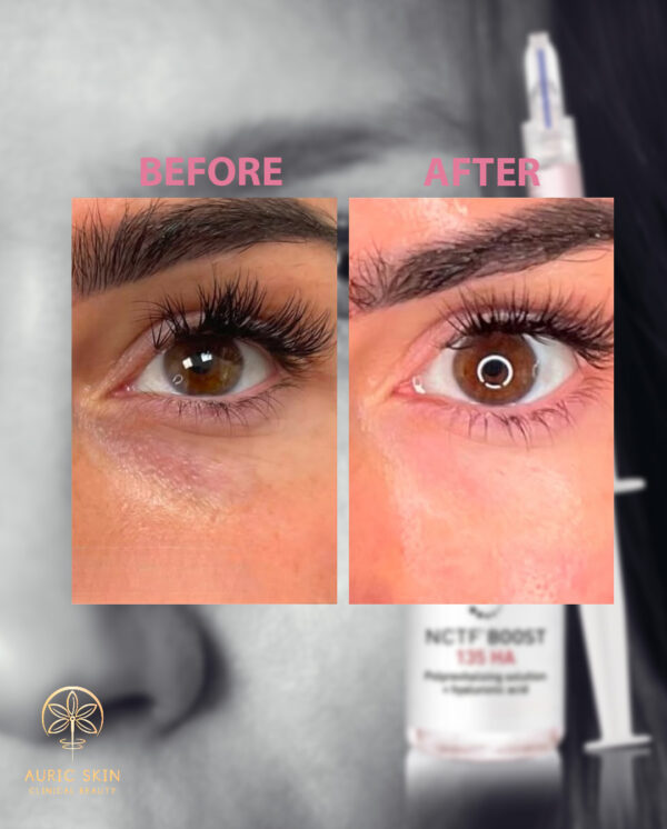 NCTF-Before-and-after-image-03