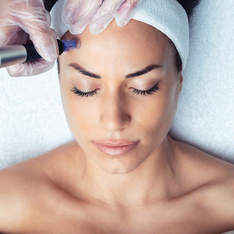 Exosomes-Therapy--Dermapen