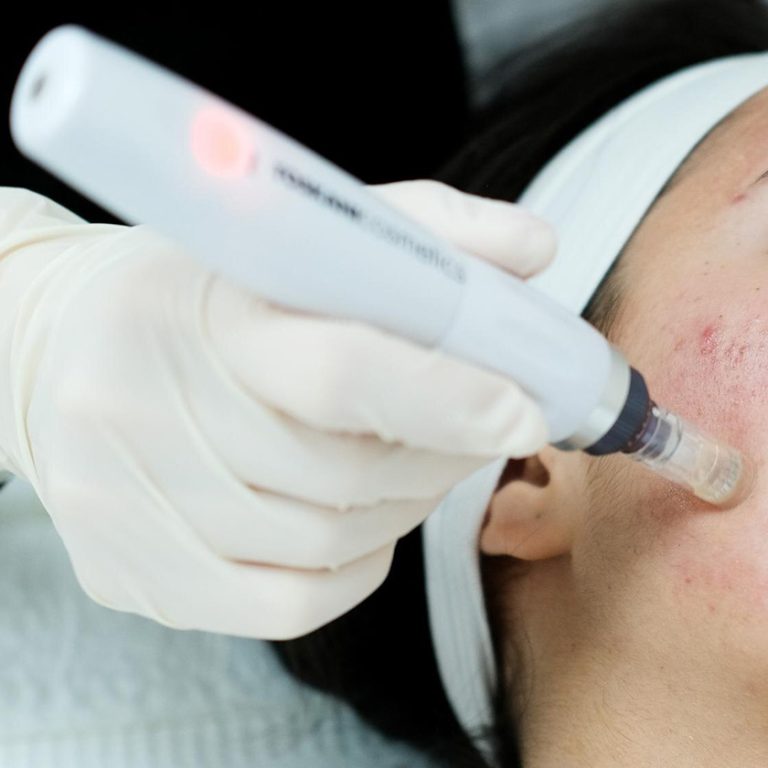 Microneedling