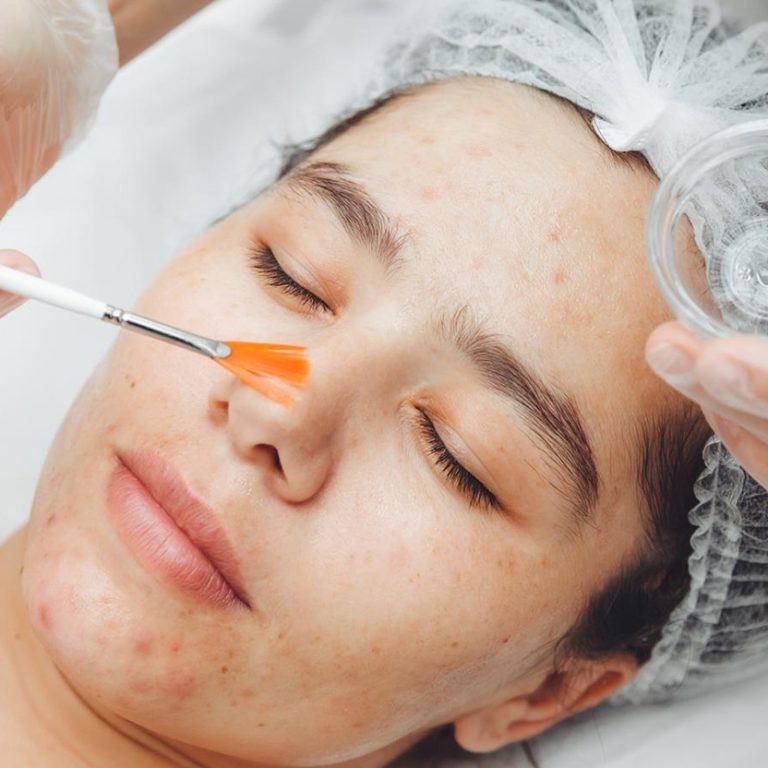 checmical-peels-featuered-image